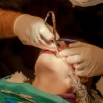 A dentist at Ridge Oral Surgery uses a dental instrument to extract a wisdom tooth from a patient's mouth.