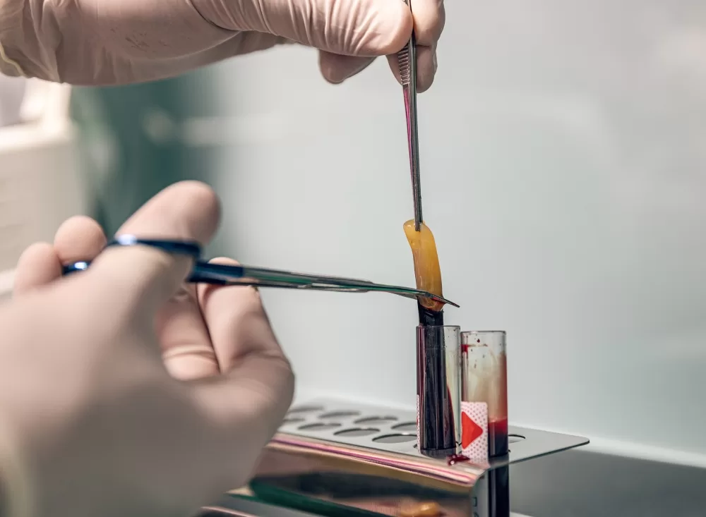 Close-up of a dental professional using forceps to handle a fibrin clot during PRF (Platelet-Rich Fibrin) preparation.