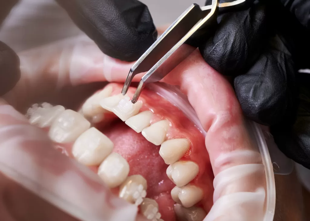 A dental professional uses tweezers to work on a patient's teeth, which appear to have orthodontic appliances.