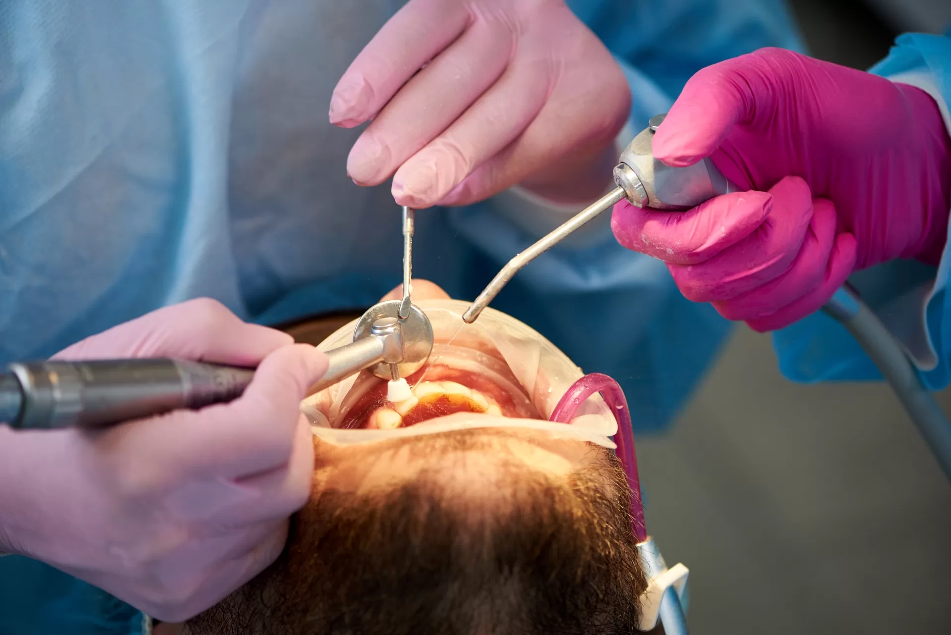 Two dental professionals perform a scaling and polishing procedure on a patient's teeth.