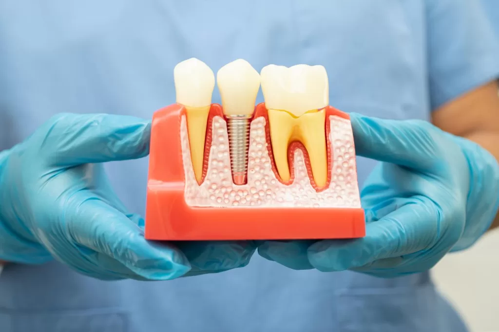 Dental Implants