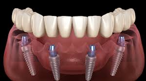 Dental implants are a permanent solution for replacing missing teeth, offering a natural look and restored function.