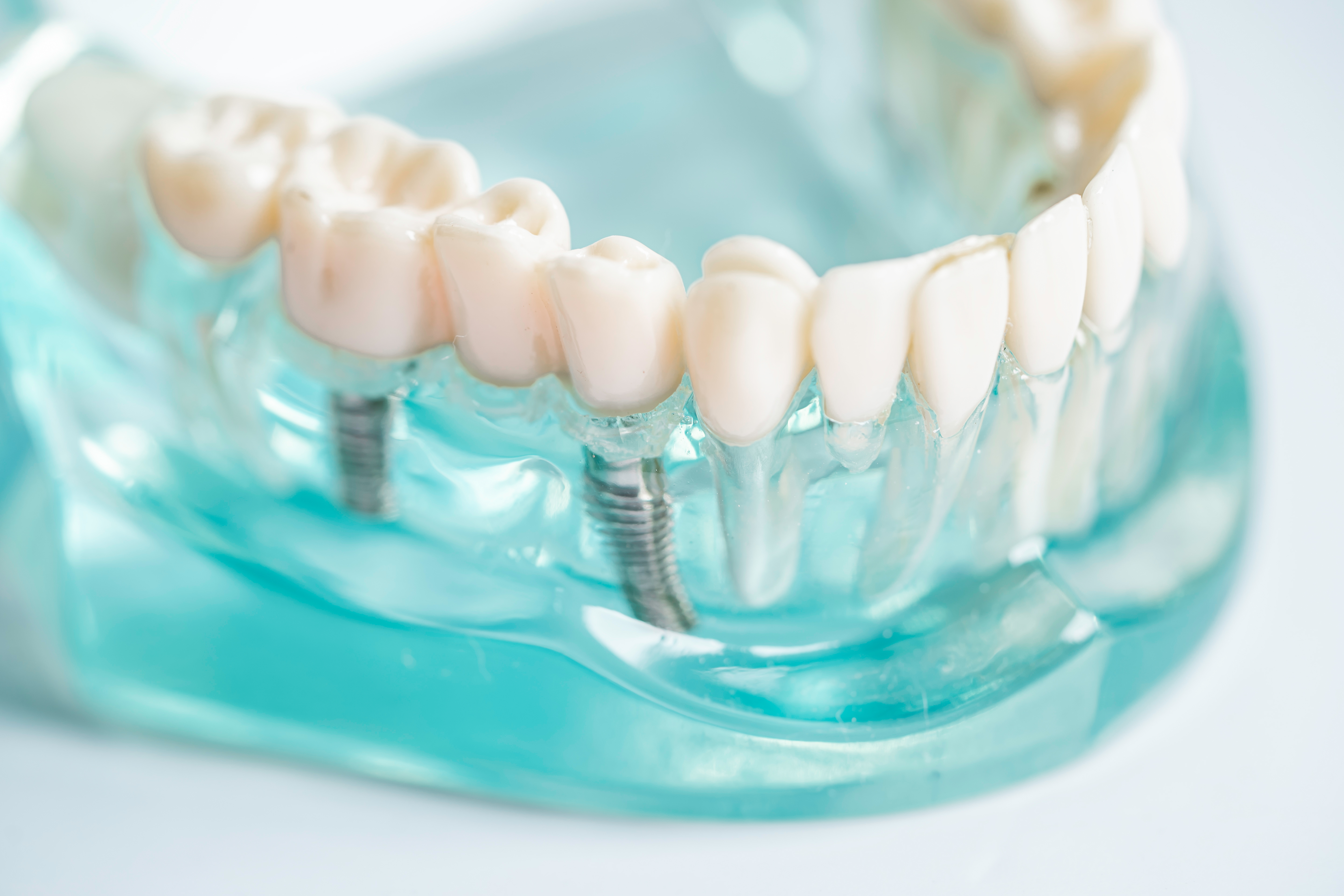 Clinical illustration of a dental implant inserted into the jawbone with surrounding graft material for added support and healing.