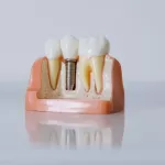 Dental Implant set