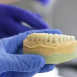 A medical image of a dental model with a bone graft placed in the jaw to promote bone growth, showing surrounding teeth.