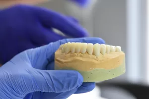 A medical image of a dental model with a bone graft placed in the jaw to promote bone growth, showing surrounding teeth.