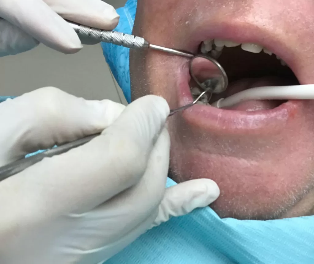 Dental professional performing a dental bone grafting procedure.