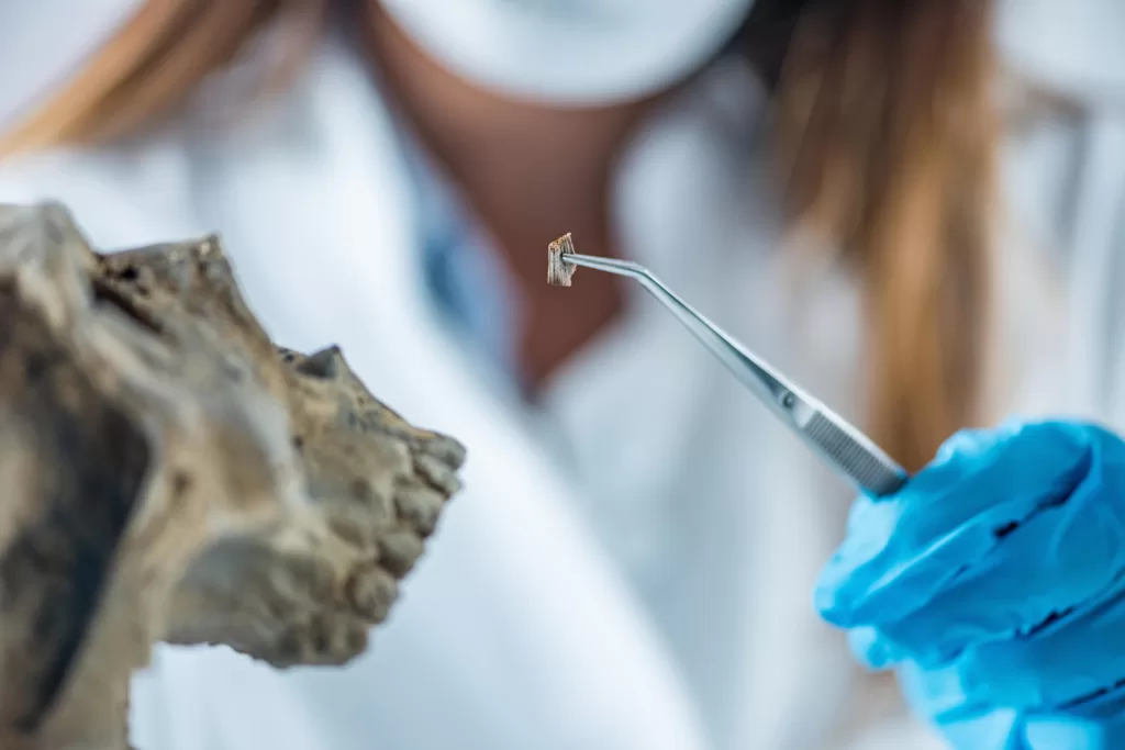 A dentist holding a small grafting material with tweezers, showcasing a key step in the dental bone grafting procedure. 