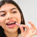 A girl cleaning her braces with interdental brush to maintain good oral hygiene.