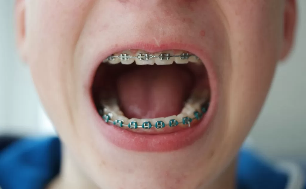 Close-up of a person's mouth with braces, highlighting the importance of good oral hygiene during orthodontic treatment.