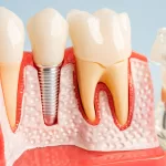 Dental implant with bone loss model