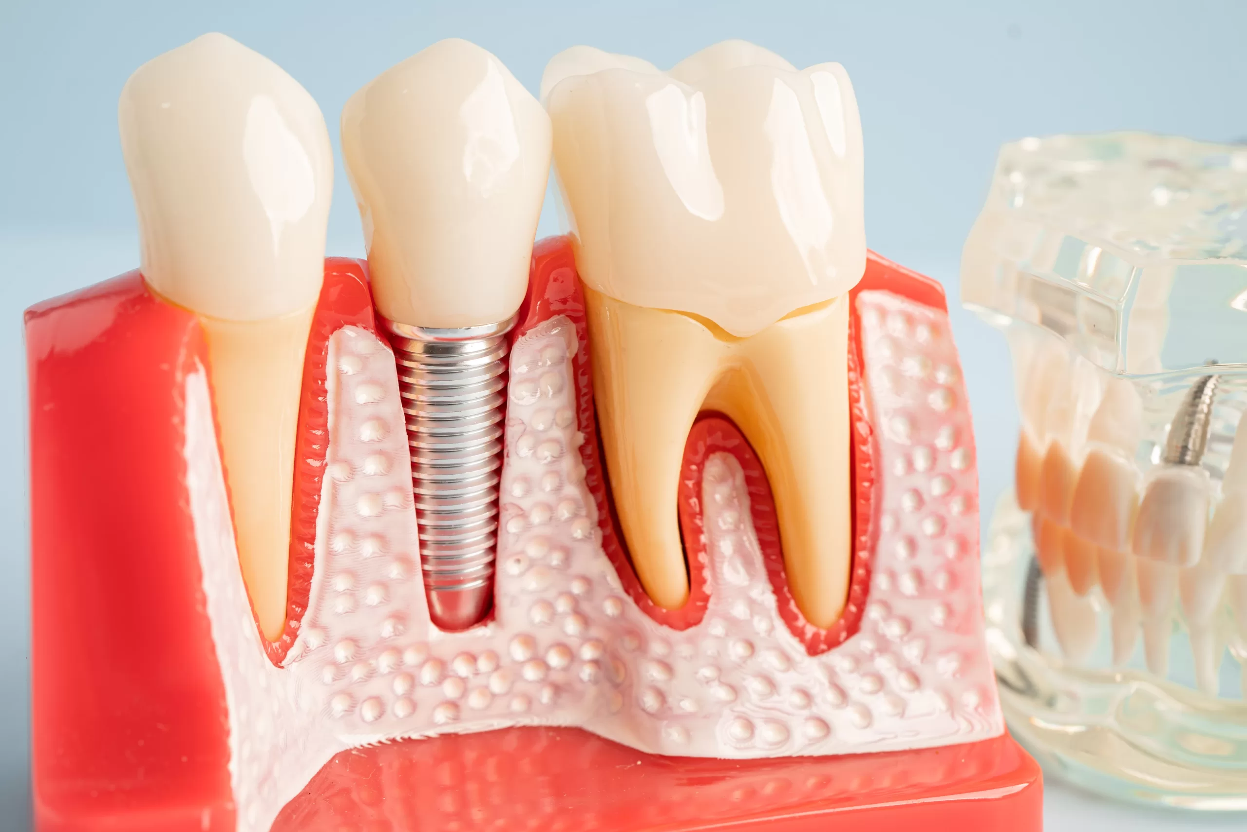 Dental implant with bone loss model