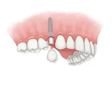 An illustration depicting a dental implant being placed into the jawbone, with a dental crown attached to the implant.