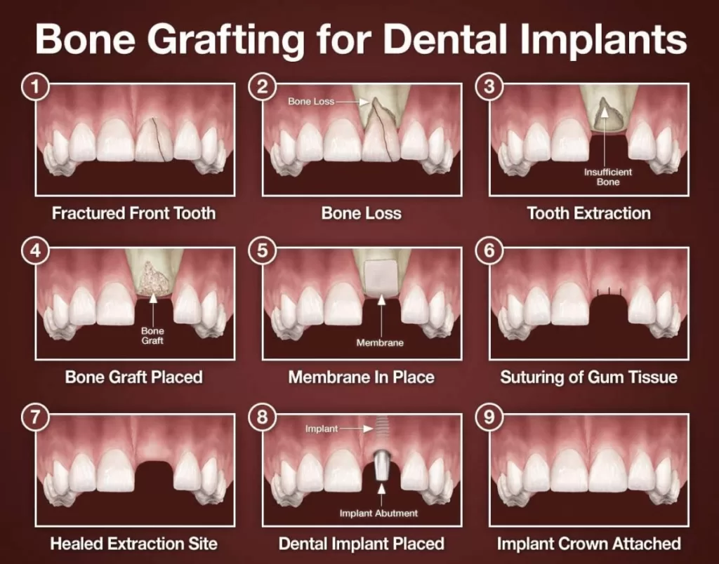 An illustration showing the step-by-step process of bone grafting for dental implants