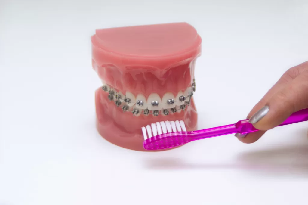 Close-up of a toothbrush brushing a dental model with braces, emphasizing the importance of good oral hygiene during orthodontic treatment.