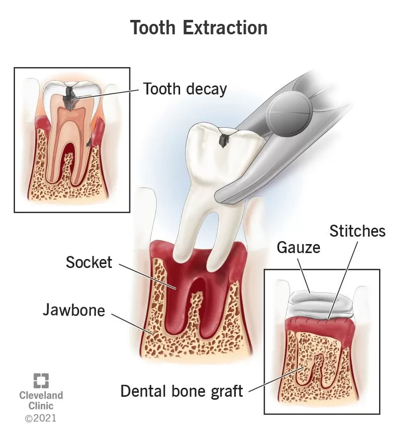 Understanding the tooth extraction procedure.