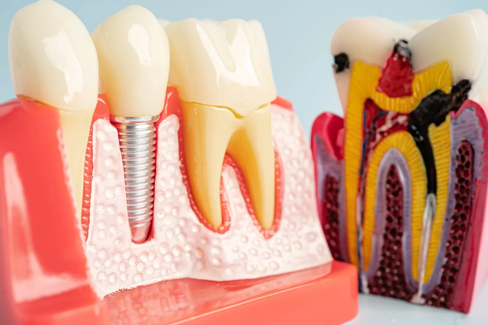 A detailed dental model illustrating a dental implant placed in the gum and jawbone, alongside natural teeth. The implant's titanium screw, abutment, and ceramic crown are clearly visible, showcasing how it integrates with the gum tissue. The model also includes a cross-section of a natural tooth, displaying layers such as enamel, dentin, and pulp, highlighting the anatomy of teeth and the implant process.