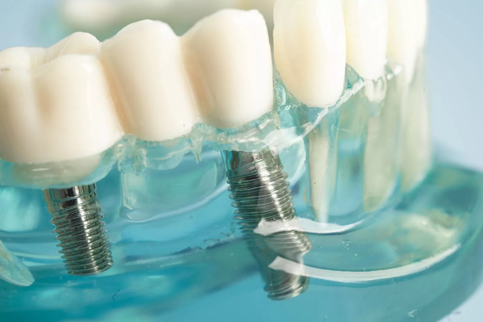 Close up of two dental implants.