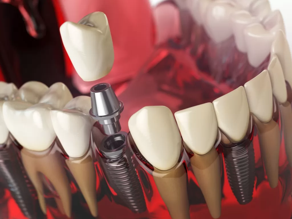 A 3D illustration showing a dental implant being placed into the jawbone, with a crown attached.