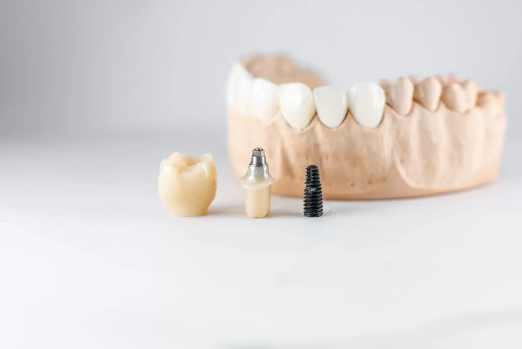 A dental implant, a crown, and an abutment on a white surface with a dental model in the background.