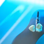 Close-up shot of a dental implant on a blue backdrop.