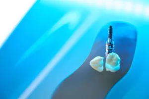 Close-up shot of a dental implant on a blue backdrop.