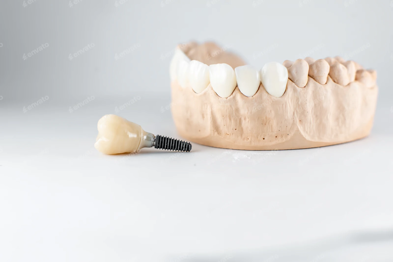 Close-up on plaster model of artificial jaw and dental implant on the white background
