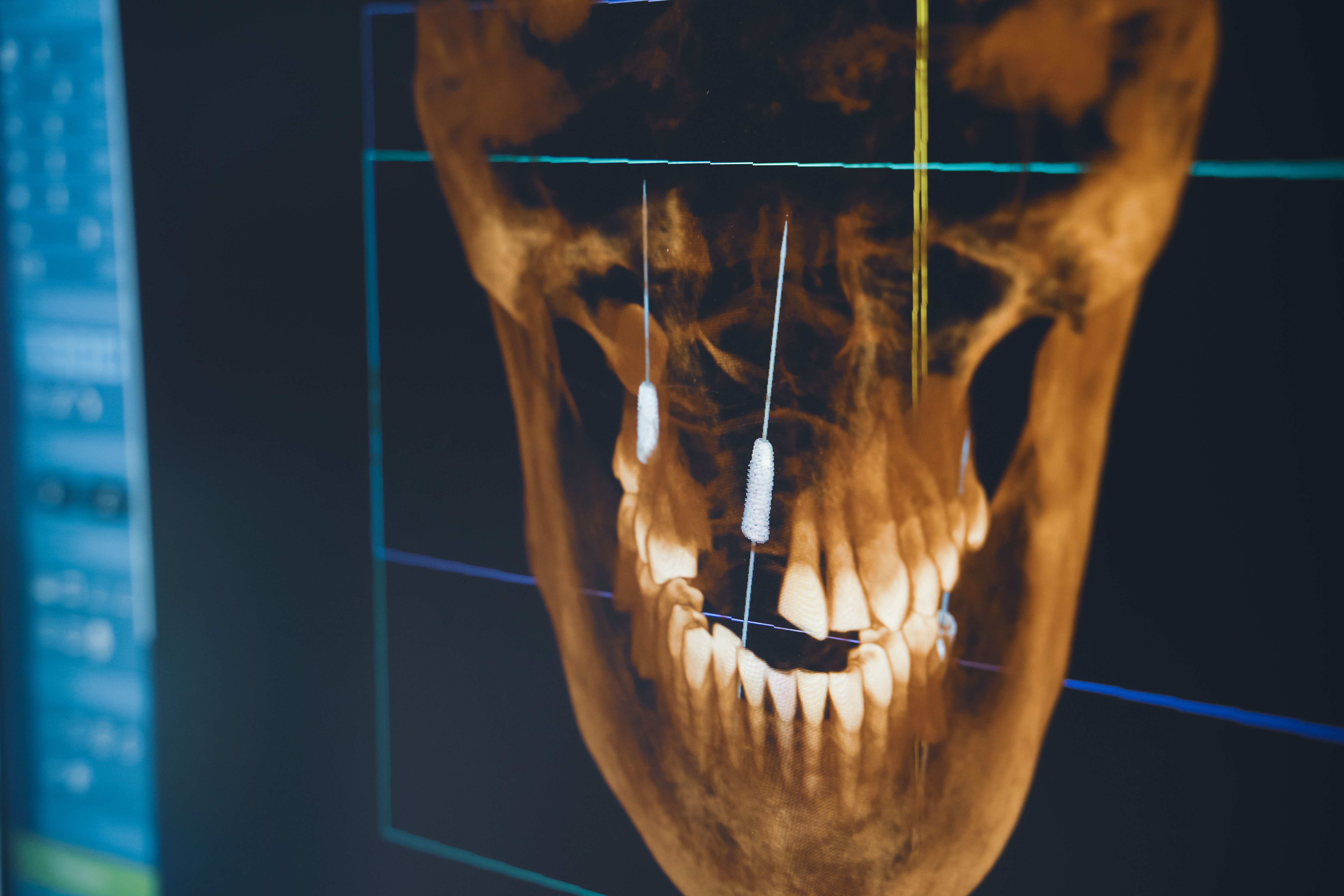 Dental X-ray image displaying a human jaw and teeth with visible implants against a dark background.