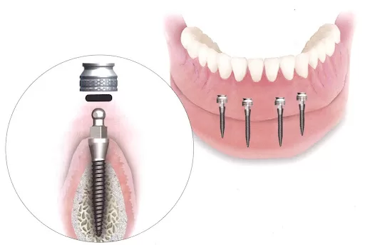 Cross‑section of lower jaw with single‑piece mini dental implant under 3 mm diameter.