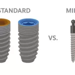 Comparison of mini vs standard dental implant showing size difference and jaw placement.
