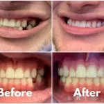 Before and after photo showing a dental transformation, with improved teeth alignment and appearance.
