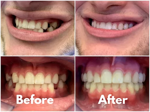 Before and after photo showing a dental transformation, with improved teeth alignment and appearance.