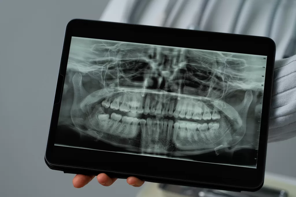 CBCT dental scan on a tablet showing an impacted canine near tooth roots.