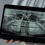 CBCT dental scan on a tablet showing an impacted canine near tooth roots.