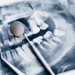 Dental X-ray showing impacted wisdom teeth and molars in Ridge Oral Surgery clinic.