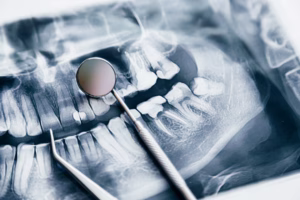Dental X-ray showing impacted wisdom teeth and molars in Ridge Oral Surgery clinic.