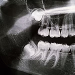 Panoramic dental X-ray showing an impacted lower wisdom tooth positioned sideways beneath the gum and bone.