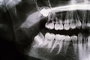 Panoramic dental X-ray showing an impacted lower wisdom tooth positioned sideways beneath the gum and bone.