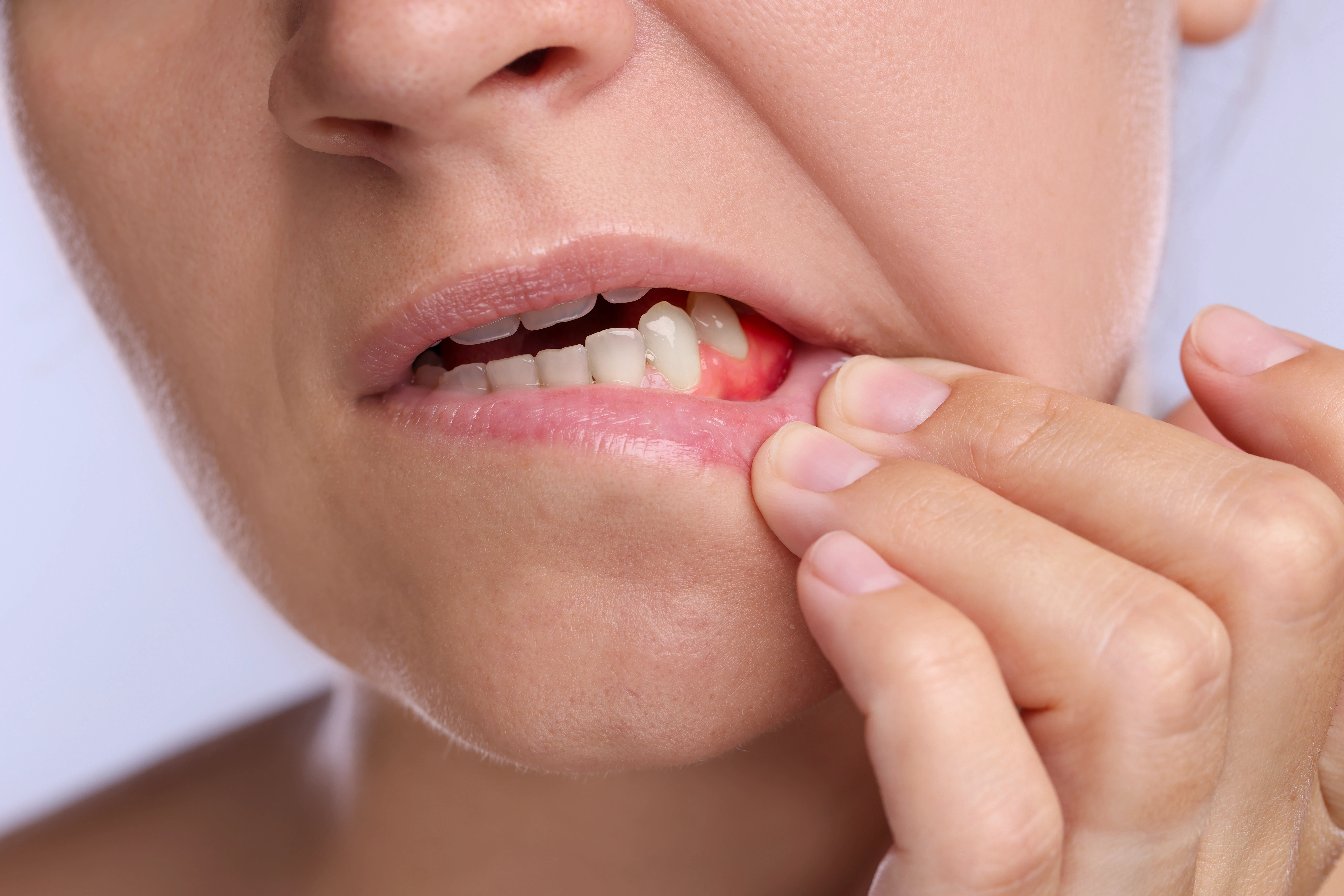 Woman showing swollen and inflamed gums, ready to be treated in Ridge Oral Surgery Clinic.