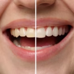 Dental examination showing teeth and gums being checked with a dental mirror.