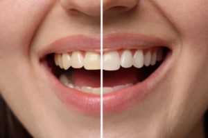 Dental examination showing teeth and gums being checked with a dental mirror.