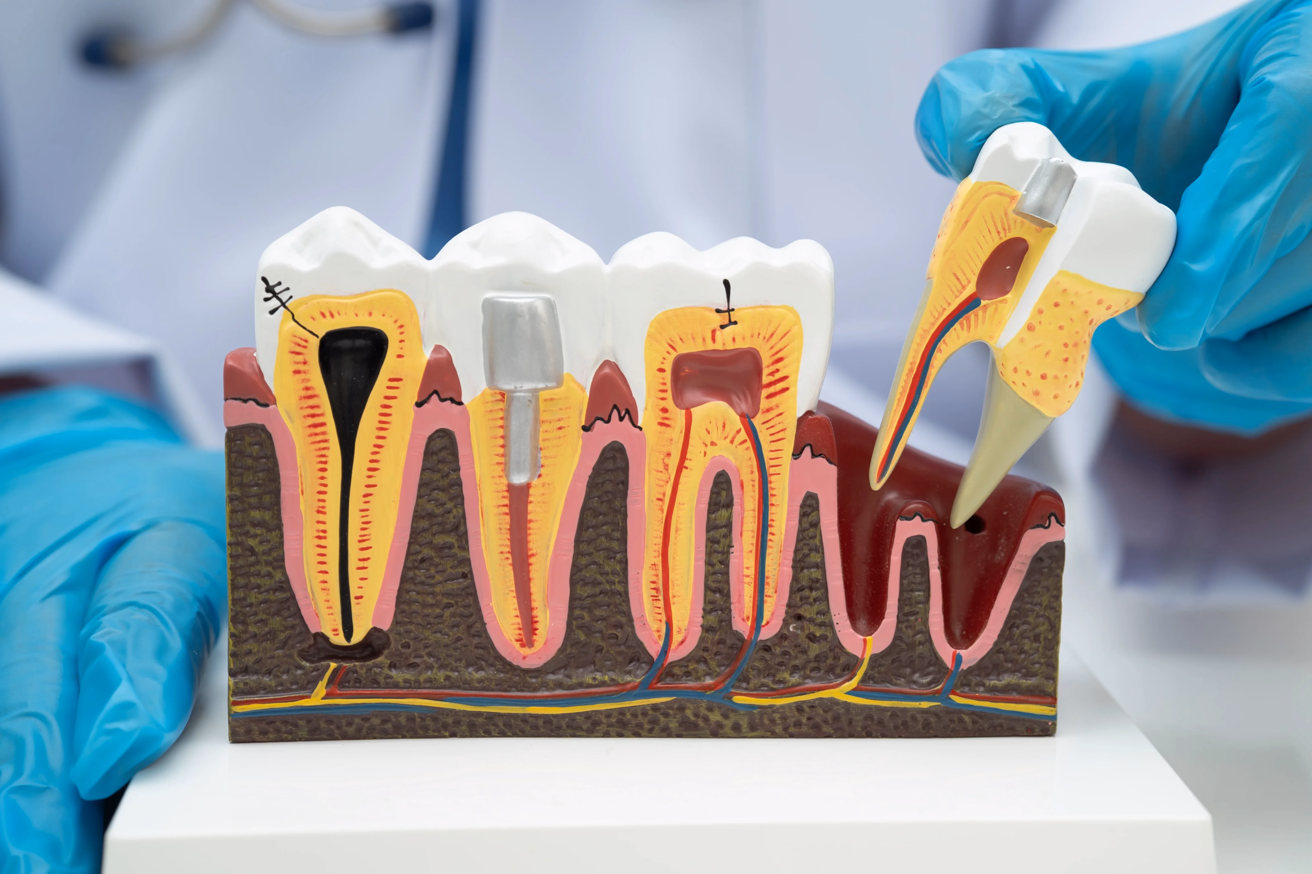 Dental tooth anatomy model showing tooth extraction and root structure for oral surgery education.